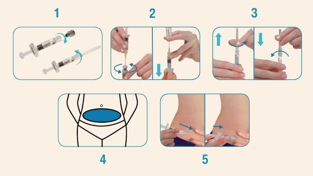 Five illustrated steps of the Cetrotide injection: assembling the syringe, mixing, removing air, choosing the abdomen site, injecting