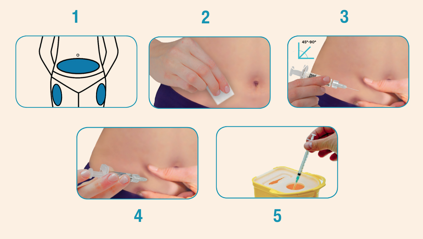 Illustrated Orgalutran steps: cleaning the injection site, pinching a fold of skin, inserting the needle at 90 degrees, and pressing the plunger slowly